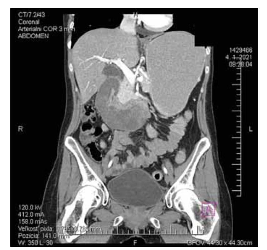 CT obraz spontánneho intramurálneho hematómu
duodena – dilatácia duodena, intraluminálne s denzným
obsahom, s difúzne zhrubnutou stenou tenkého čreva
a v jeho okolí voľna tekutina zvýšenej denzity.<br>
Fig. 2. CT scan of a spontaneous intramural duodenal
hematoma – dilatation of the duodenum, intraluminal dense
content, diffusely thickened wall of the duodenum, free fluid
of increased density.