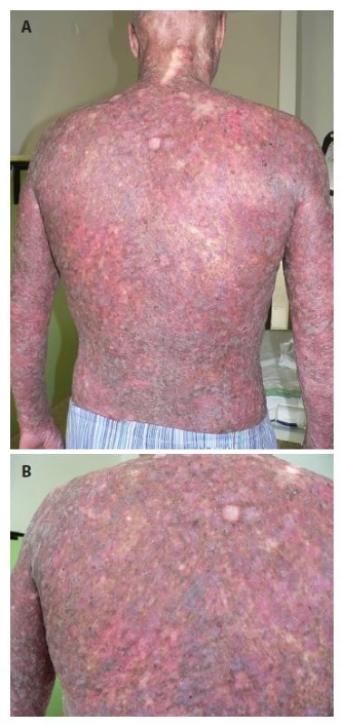 a. Klinický obraz poikilodermie na zádech pacienta<br>
Obr. 1b. Detail kožního postižení levé lopatky
Přítomná deskvamace, poikilodermie (síťovitá hyper- a hypopigmentace,
teleangiektázie, atrofie kůže).