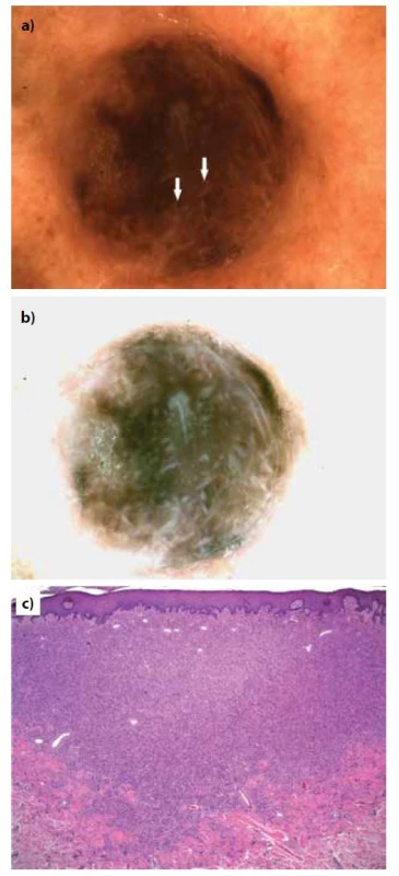 Pacientka, 80 let, hemosiderotický fibrózní histiocytom
z přední strany levého bérce<br>
a) dermatoskopický obraz s přítomností jasných bílých
proužků (šipky)<br>
b) normalizovaný dermatoskopický obraz, který jasné bílé
proužky zvýrazní<br>
c) histopatologický obraz (HE, 25x).