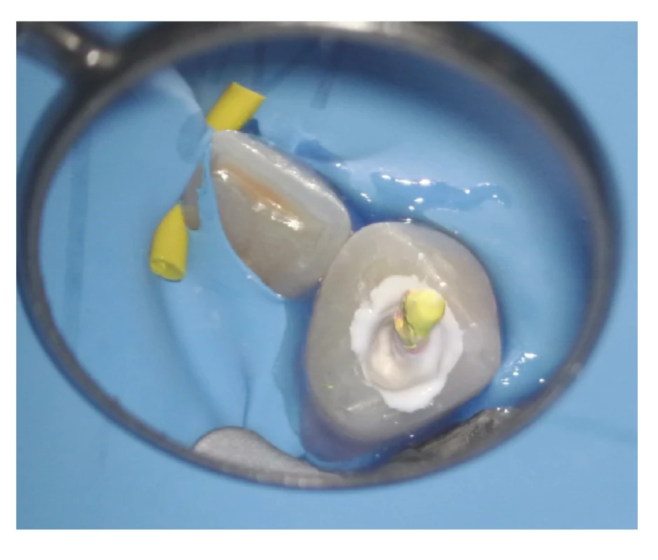 Pohled do dřeňové dutiny zubu, kanálek byl vyplněn fillerem a kalibrovaným gutaperčovým čepem <br>
Fig. 4 Root canal filled with calibrated gutta-percha cone and bioceramic-based sealer in abundance
