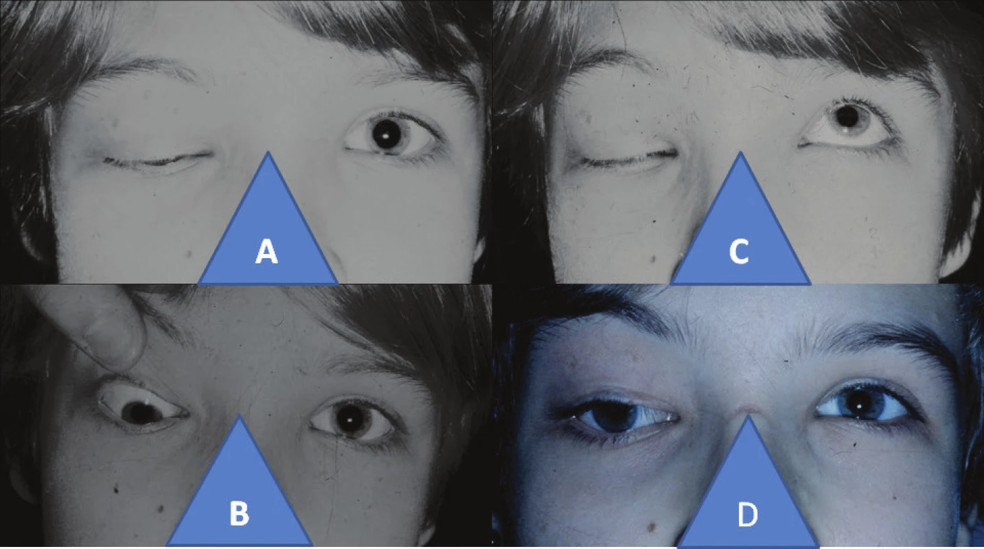 11-year-old girl with right-sided congenital fibrosis of extraocular muscles: closed ocular aperture in right eye (A), hypotropia in right eye with passive opening of ocular aperture (B), zero ability to open ocular aperture in right eye upon attempt at elevation (C), position of upper eyelid and eyeball in right eye four years after comprehensive triple surgical procedure according to cul-de-sac, Knapp procedure, according to Fox (D)