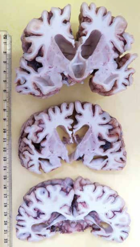 Pohľad na rezné plochy mozgu s výraznou atrofiou kôry a vnútorným
hydrocefalom.