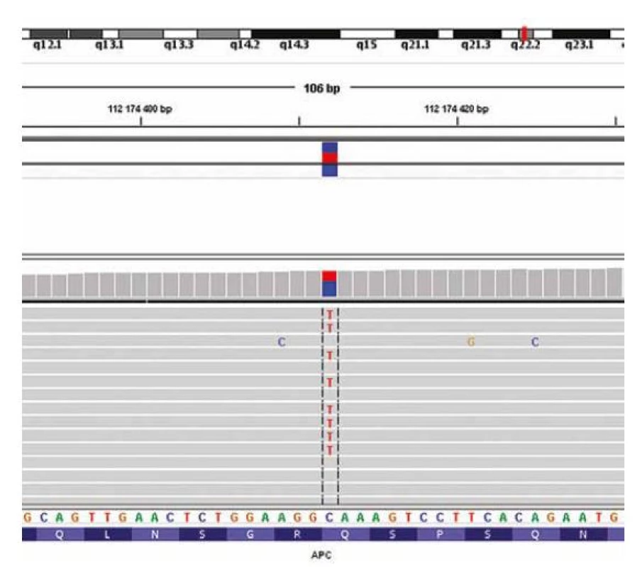 Obrázek zobrazující mutaci v APC genu detekovanou (v odoperovaném
nádoru) pomocí sekvenování nové generace a vizualizovanou programem
Integrative Genomics Viewer.
