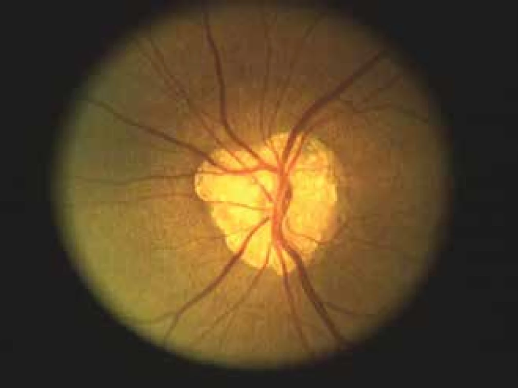 Photograph of a large complex of optic disc drusens