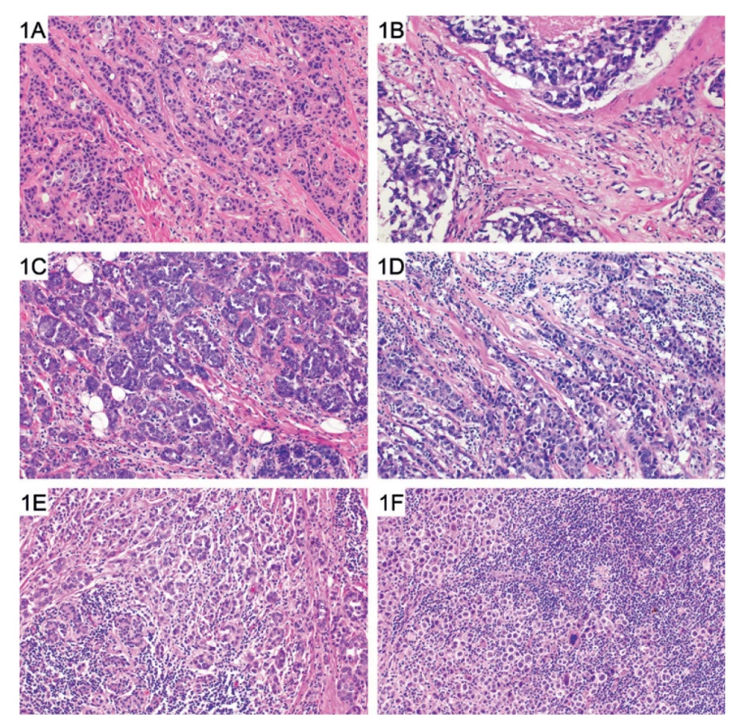 Příklady denzity tumor infiltrujících lymfocytů (TIL) u karcinomu prsu (HE, 200x) (nejedná se o referenční standardy). Zcela ojedinělé TIL
(hodnoceno jako 0 %) (A). Sporadické lymfocyty v části stromatu (hodnoceno jako 10 %) (B). Disperzně přítomné lymfocyty - hodnoceno jako
20 % (C) a 30 % (D). Četné stromální lymfocyty - hodnoceno jako 60 % (E) a > 90 % (F).