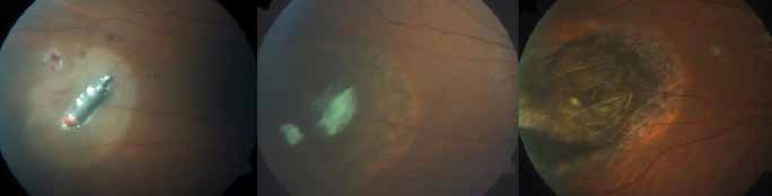 Patient no. 13 – finding before procedure and development of scar after extraction of IOFB and external cryoretinopexy 