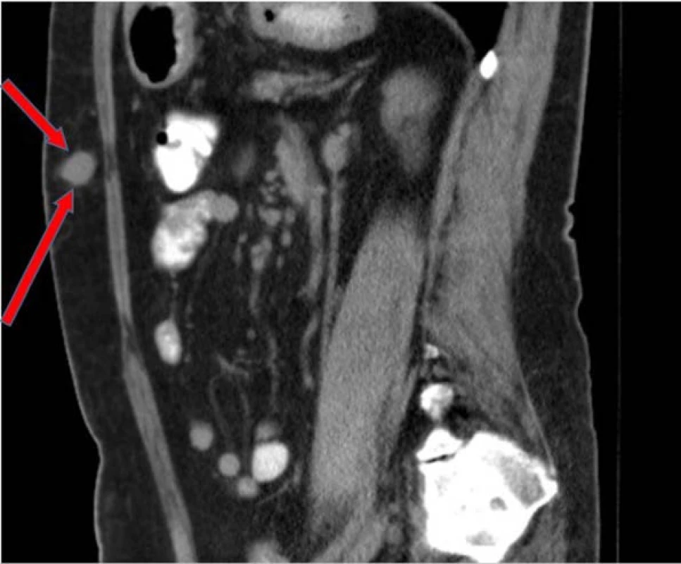 Metastáza v oblasti podkoží
břišní stěny dle CT zobrazení z druhé
poloviny května 2016<br>
Fig. 3. Metastasis in the abdominal
wall subcutaneous – CT May, 2016
