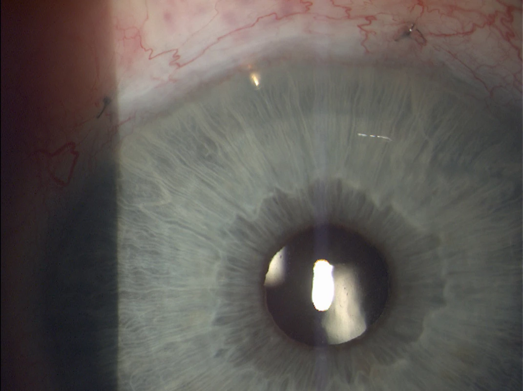 EX-PRESS implant located in the upper outer quadrant of the right eye (Source: own processing, year: 2015)
