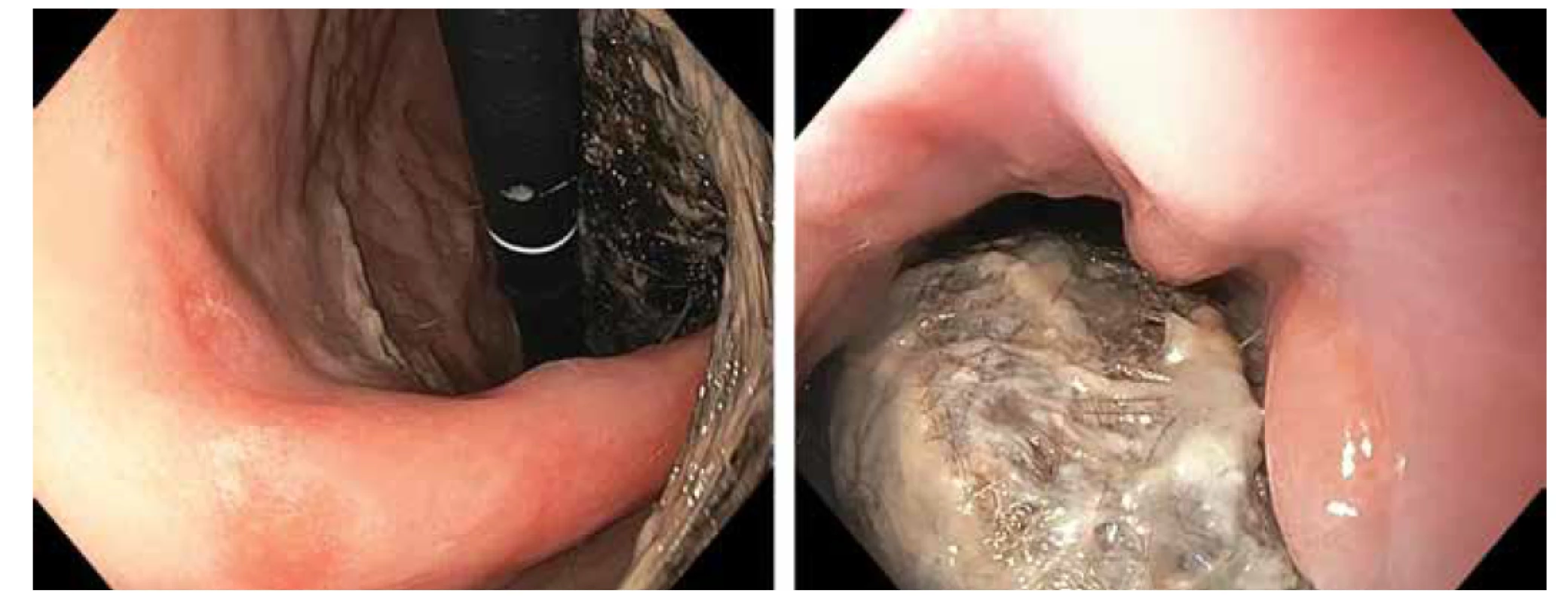 Gastroskopický nález - objemný trichobezoár vyplňující žaludek a zasahující do bulbu duodena.<br>
Fig. 2. Gastroscopy: large trichobezoar fills gastric lumen and extends to duodenal bulb.
