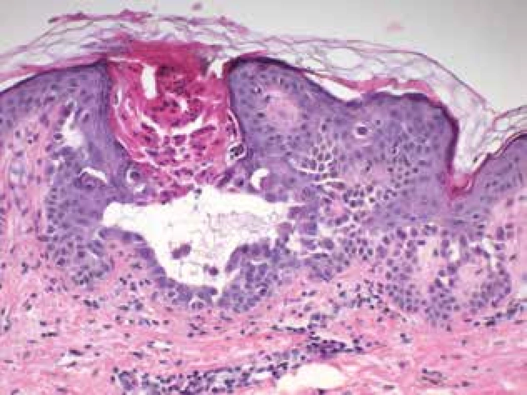 Histologický obraz s  papilomatózou, suprabazální akantolýzou, dyskeratózou, hyperkeratózou a lymfocytárním infiltrátem v přilehlém horním koriu