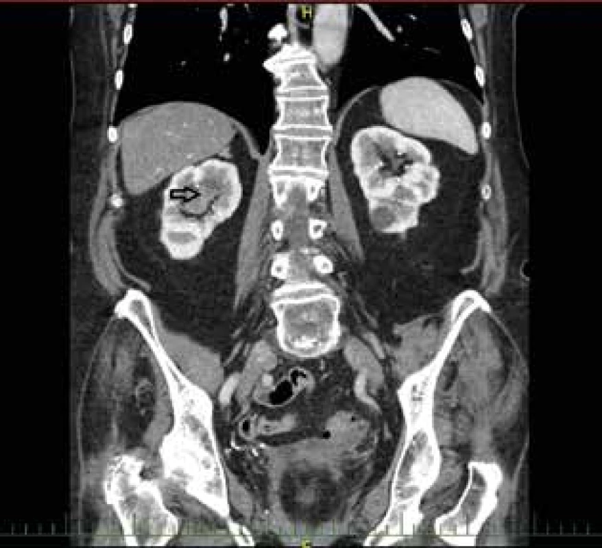  Uroteliální karcinom pánvičky pravé ledviny – CT<br>
Fig. 5: Urothelial carcinoma of the renal pelvis of the right
kidney – CT