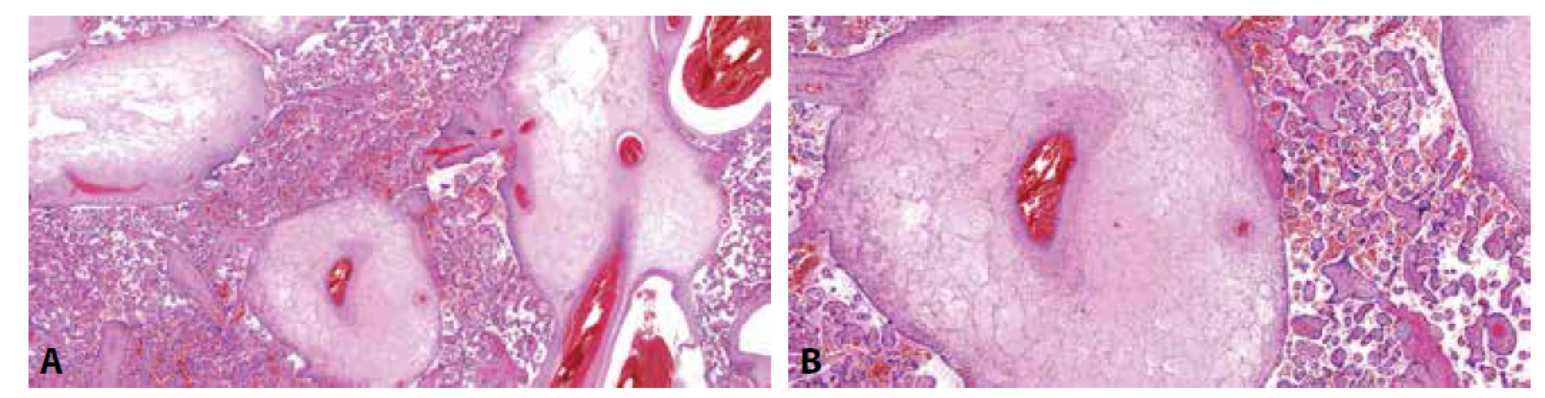 PMD. A: Edématózní kmenové klky bez hyperplázie vilózního trofoblastu. Distální choriové klky bez
signifikantních změn (HE, 50x). B: PMD. Kmenový klk s edémem stromatu a silnostěnnými cévami (HE, 100x).