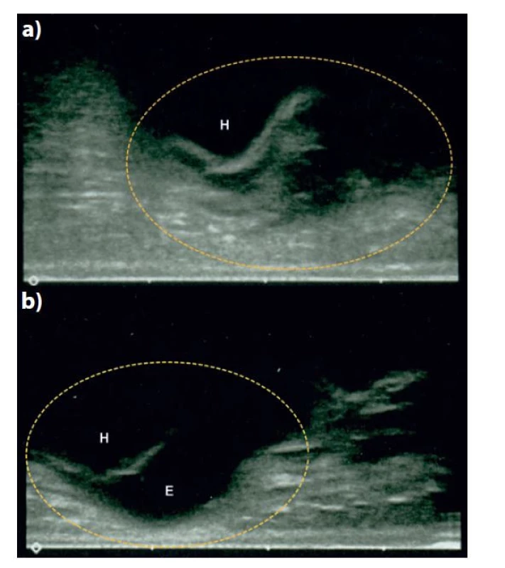Ultrazvukové vyšetření poraněného lokte<br>
a) S vyznačením lůžka odlomeného mediálního epikondylu
na distálním humeru (H) a srovnávací zobrazení zdravého lokte,
b) s vyznačením stejné oblasti a zachycením normálního
obrazu mediálního epikondylu (E). Hyperechogenní linie ve
struktuře kosti představuje hranici osifikované části distálního
humeru, anechogenní oblast chrupavku neosifikovaného
mediálního epikondylu (pouze b).<br>
Fig. 2: Ultrasound imaging of the injured elbowbr<br>
a) Distal humerus (H) with the region of the fracture site highlighted,
in comparison with b) the uninjured elbow with the
same region highlighted and showing normal image of the
medial epicondyle (E). The hyperechoic line in the bone structure
is the bordeline of the ossified distal humerus; the anechoic
region represents the cartilaginous medial epicondyle (only b).