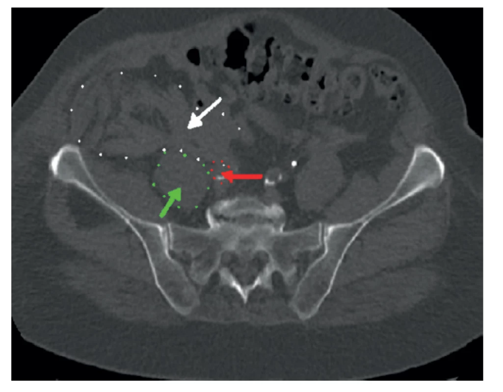 Netraumatické retroperitoneální krvácení (bílá
šipka) u 94leté pacientky, zelená šipka – musculus psas,
červená šipka − pánevní tepna<br>
Fig. 2: Non-traumatic retroperitoneal hemorrhage ( white
arrow) in a 94-year-old female patient, green arrow −
musculus psoas, red arrow − pelvic artery