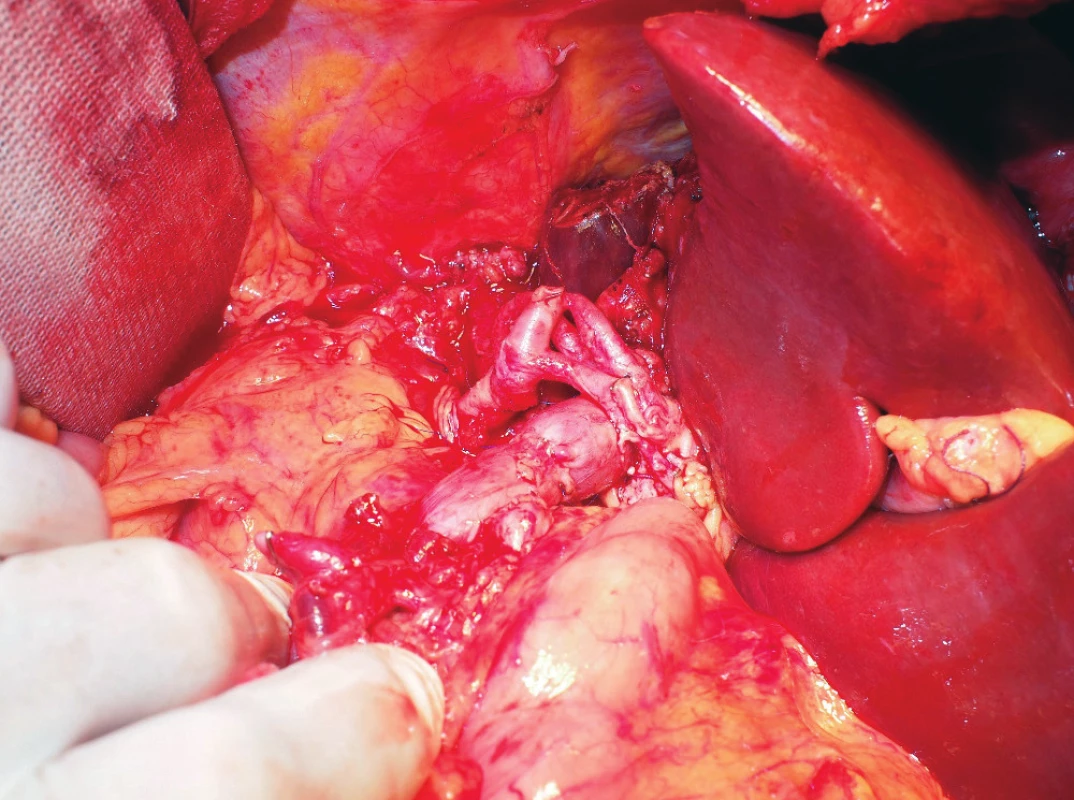A detailed view of the established portal vein
anastomosis and aortohepatic bypass<br>
The picture was taken after reperfusion of the graft. The biliary
duct anastomosis is not clearly visible in this image.
