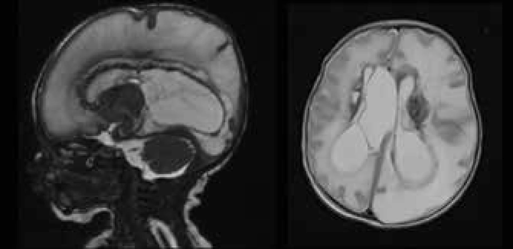 MRI examination of CNS – extensive ischemic-pseudocystic
changes of both brain hemispheres, husky parenchyma on left and
bilaterally evident periventricular haemorrhage.
