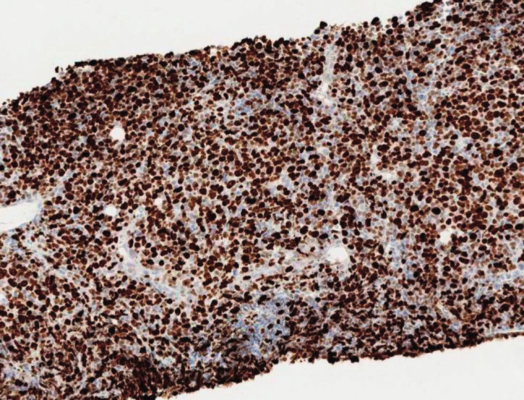 Histologie z biopsie mízní uzliny, zvětšení 100×, vysoká pozitivita Richterova syndromu při imunohistochemickém barvení Ki-67