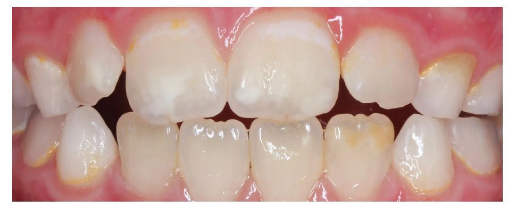 Bílé opacity na zubech 12,
11, 21 a hnědá opacita na
zubu 32<br>
Fig. 1
White opacities on the teeth 12,
11, 21, and a brown opacity on
the tooth 32