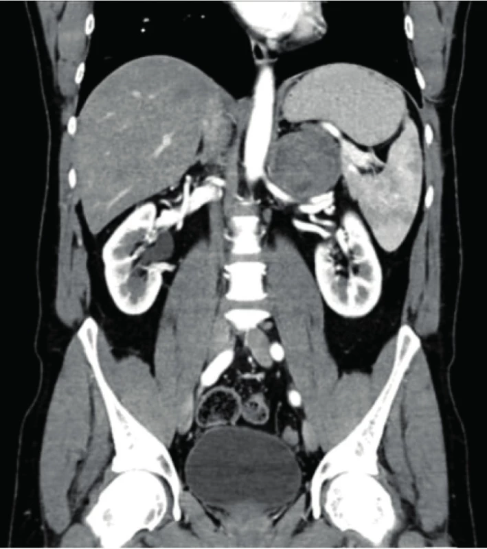 Tumor levé nadledviny<br>
Fig. 2. Left adrenal tumor