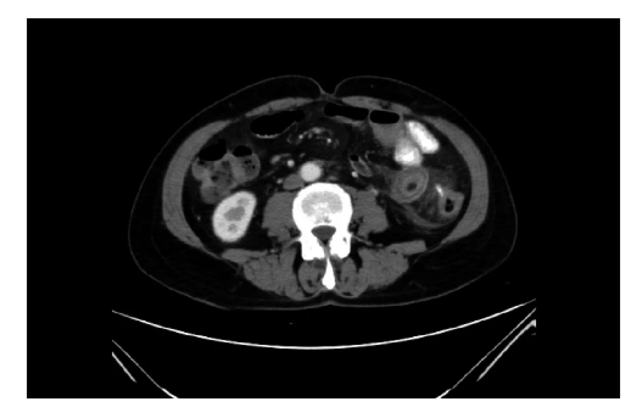 Axiální CT řez s nálezem cizího tělesa s průkazem
perforace tračníku<br>
Fig. 2: Axial CT section with evidence of a foreign body
and descending colon perforation