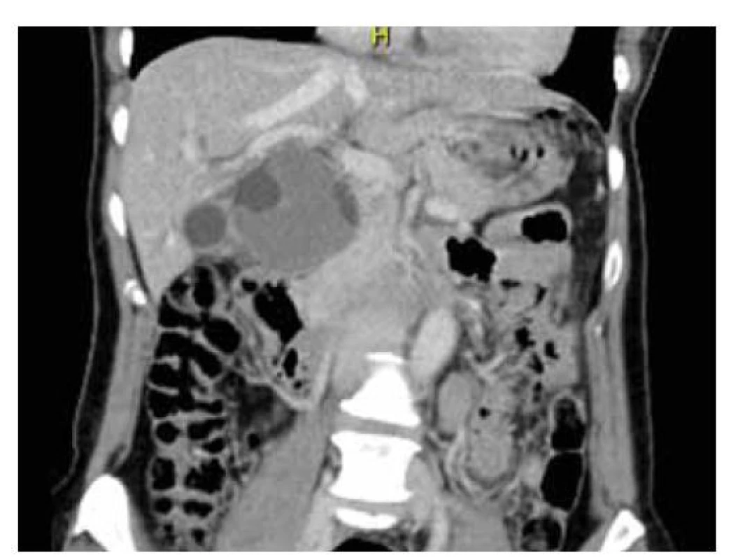 CT břicha: solidně-cystické ložisko subhepatálně
s útlakem žlučovodu.<br>
Fig. 2. CT of the abdomen: solid-cystic lesion subhepatic with
bile duct oppression.