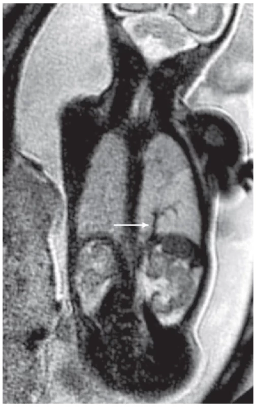 A 25-week-old fetus with bronchopulmonary sequestration
of the left lung. A coronal T2-weighted Single-Shot Turbo Spin
Echo (SSTSE) sequence at 1.5-T MRI demonstrate bronchopulmonary
sequestration with anomalous arterial supply (arrow).