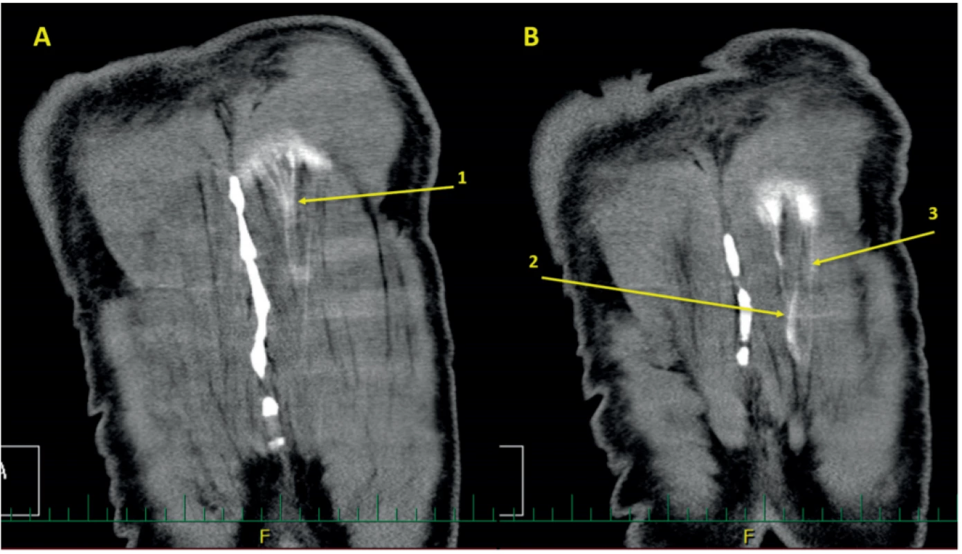 Vertikální CT řezy ze shodného vyšetření jako na obr. 8. A. povrchnější řez ukazuje kraniální hranice anestetika. Tvar kontrastu připomíná obraz
začátku m. iliocostalis thoracis na žebrech (1). B. na hlubším řezu sledujeme distribuci anestetika od Th3 až k Th10 (2, 3)