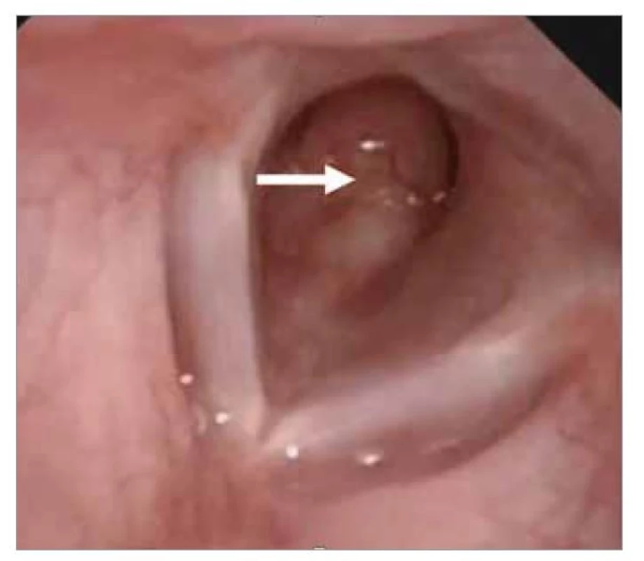 Flexibilní laryngoskopie před operací. Hladký tumor
na přední stěně průdušnice (šipka).<br>
Fig. 3. Flexible laryngoscopy before surgery. Smooth tumor
on the anterior wall of the trachea (arrow).