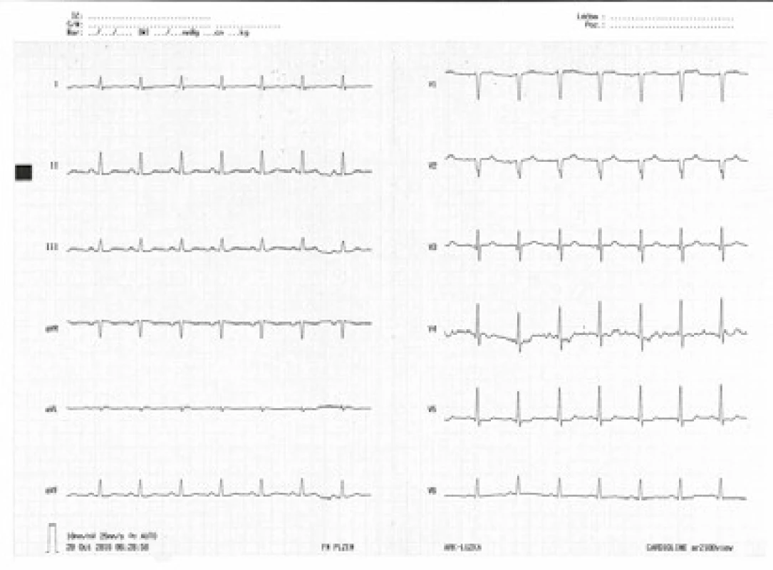 Kontrolní EKG křivka při dimisi