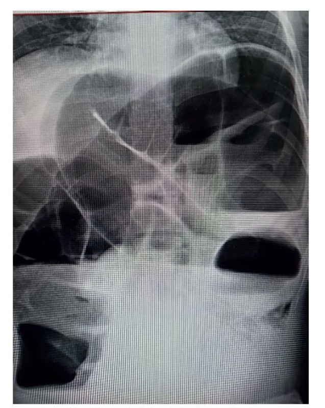 Rtg břicha<br>
Fig. 1: X-ray of the abdomen