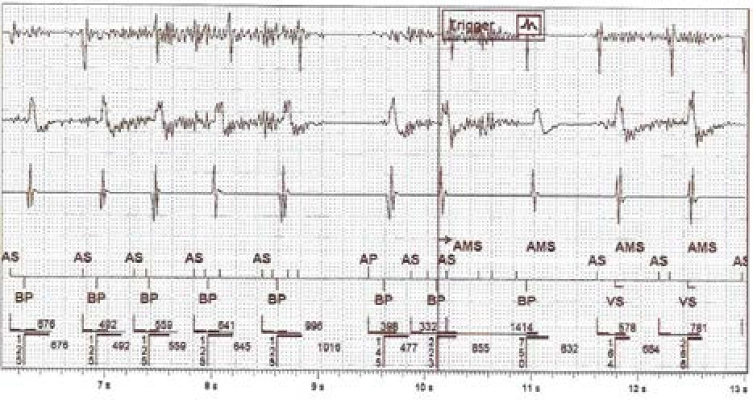 The intracardiac recording of improper detection on near-field channel (1st line is atrial, 3rd ventricular) and far-field RV Coil–Can channel (2nd line).
N.B.: Marker AS = Atrial Sense, BP = Biventricular
Pace, VS = Ventricular Sense, AMS = Automatic Mode
Switching