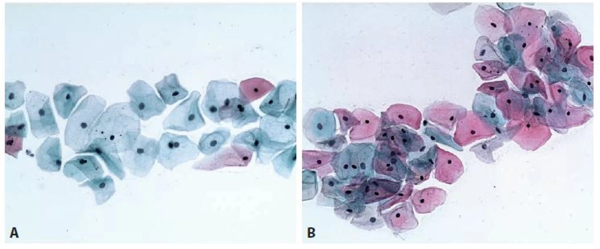 Cytogram generačního období – proliferační fáze. Intermediární buňky s většími jádry a převážně s cyanofi lní cytoplazmou a superfi -
ciální buňky s malými pyknotickými jádry a převážně eozinofi lní cytoplazmou. A: 9. den cyklu, převaha intermediárních cyanofi lních buněk.
B: 14. den cyklu – ovulační obraz. Převaha eozinofi lních superfi ciálních buněk – obraz vrcholné estrogenní stimulace epitelu. Papanicolaou, 200x.