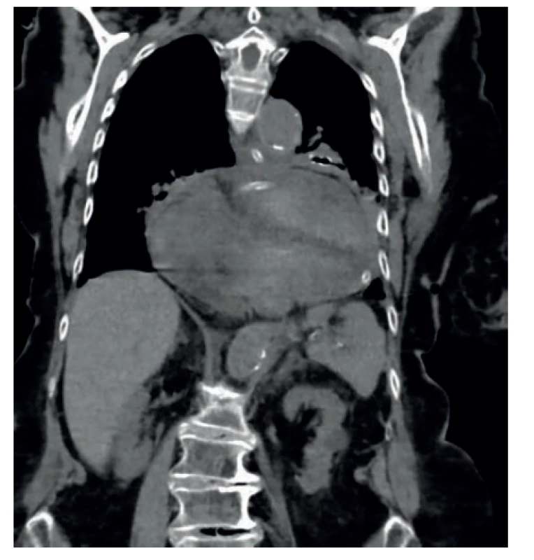 Volvulus žaludku v CT obraze se zavedenou
nazo-gastrickou sondou<br>
Fig. 2. Stomach volvulus on a CT scan with inserted
naso-gastric tube