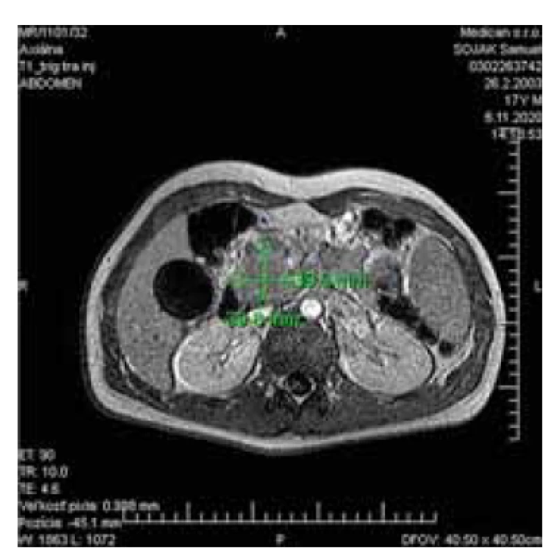 Magnetická retrográdna cholangiopankreatikografia, 
ktorá zobrazuje rozšírenú hlavu pankreasu.<br>
Fig. 1. Magnetic retrograde cholangiopancreatography
showing the dilated
head of the pancreas.