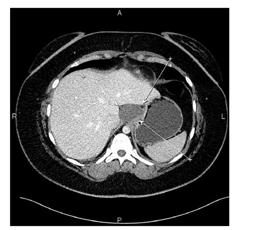 CT obraz bronchogenní cysty kardie – šipky ukazují
stěny cysty<br>
Fig. 1: CT image of the bronchogenic cyst of the cardia –
cyst walls indicated by arrows