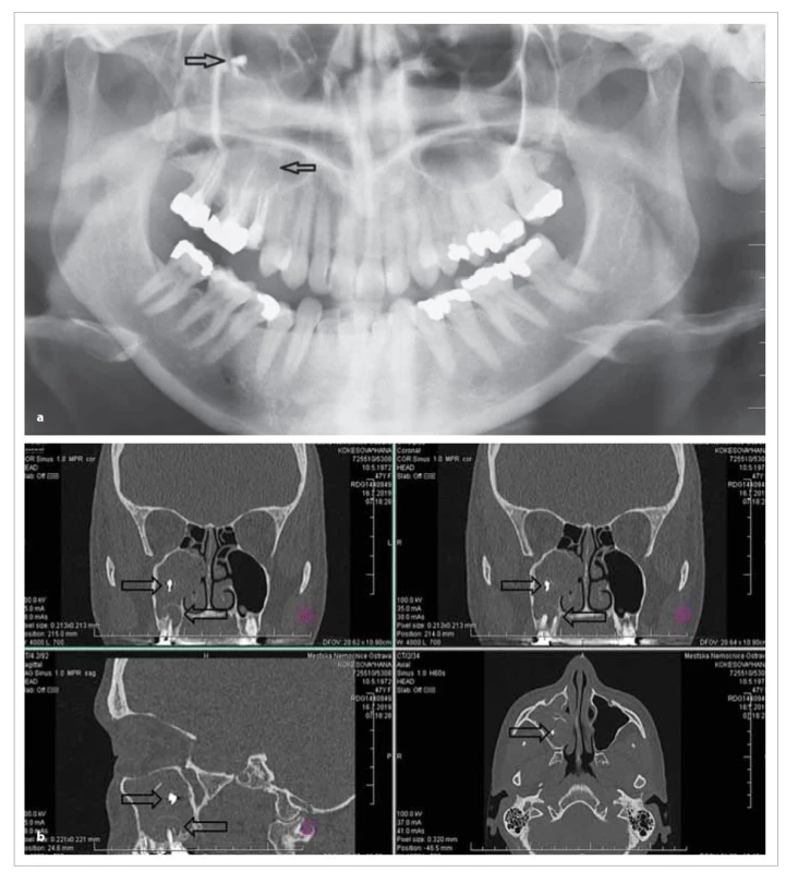 Periapikální granulom zubu 16 a fungus ball v pravé č elistní dutině na OPG (a) a CT (b).<br>
Fig. 2. Periapical lesion of tooth 16 and fungus ball in the right maxillary sinus OPG (a) and CT (b).