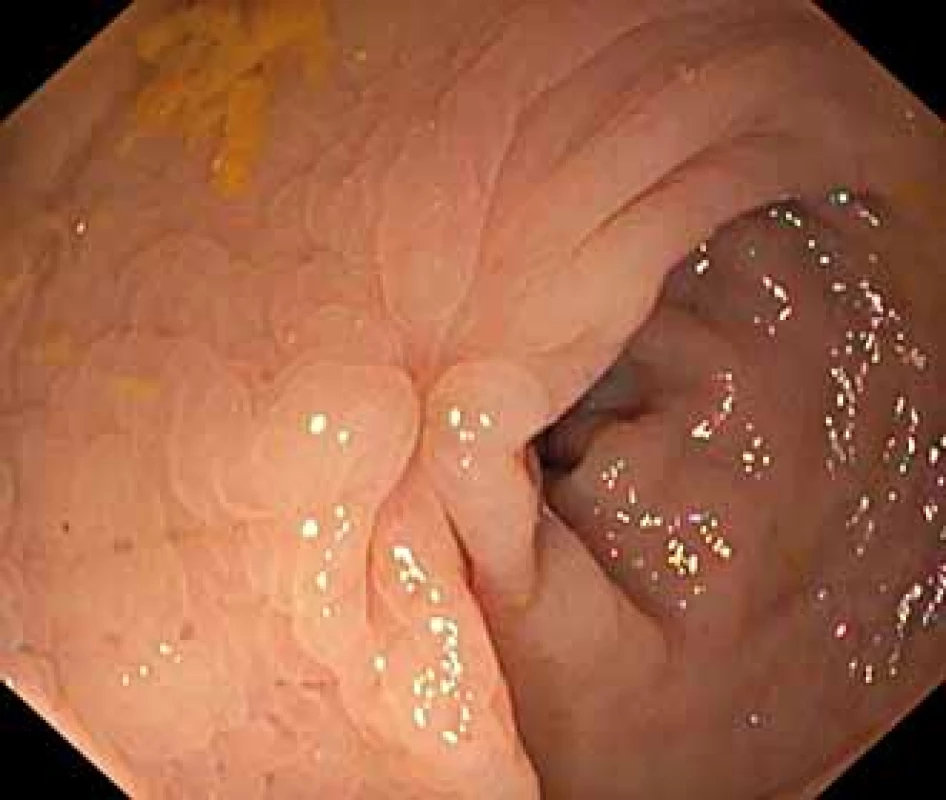 Jizva po endoskopické léčbě
lipomu rekta.
Fig. 2. Scar after endoscopic treatment
of rectal lipoma.