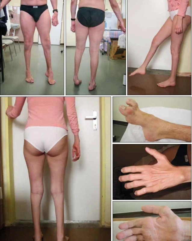 Fotografie pacientů s dědičnou neuropatií. Atrofie lýtek a typická deformita nohy s vyklenutým nártem a kladívkovými prsty. Atrofie drobných svalů ruky.[Foto: archiv Neurogenetické laboratoře]