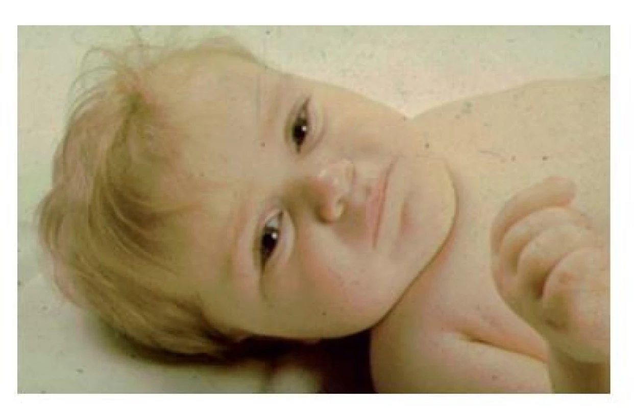 Příznačný faciální fenotyp při mutaci POU1F1 genu. Chlapec
měřil ve věku 2,5 roku 70 cm, měl růstový hormon po stimulaci
0,6 𝛍g/l, centrální hypotyreózu a hladinu prolaktinu pod dolní
hranicí detekce.
