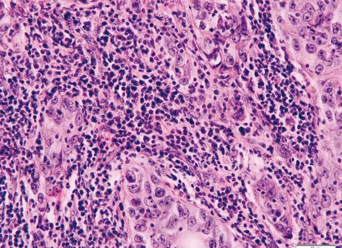 Intratumorální lymfo/plazmocytární infi ltrace uvnitř hranic tumoru při okraji
centrální fibrózy. Barveno hematoxylinem a eozinem.
