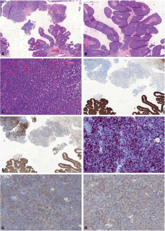 Malobuněčný karcinom s neuroendokrinními rysy smíšený s UC (A). Přítomen je jak klasický exofyticky rostoucí papilární UC (B), tak solidní okrsky tvořené high-grade karcinomem s neuroendokrinními rysy (C). UC je pozitivní v barvení CK7, naopak komponenta malobuněčného karcinomu je v CK7 negativní (D). Obě komponenty jsou pozitivní v průkazu GATA3 (neuroendokrinní karcinom pouze fokálně) (E). Malobuněčný karcinom pak vykazuje pozitivitu v barvení s neuroendokrinními markery - INSM1 (F), synaptofyzin (G), CD56 (H).