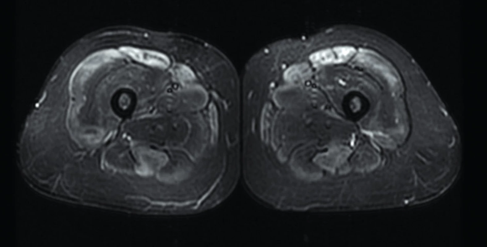 Axialní STIR sekvence – symetrické postižení předních a zadních kompartmentů u pacienta s polymyozitidou. Zdroj: Archiv Revmatologického ústavu (ÚVN Střešovice, Discovery 450; 1,5 T)