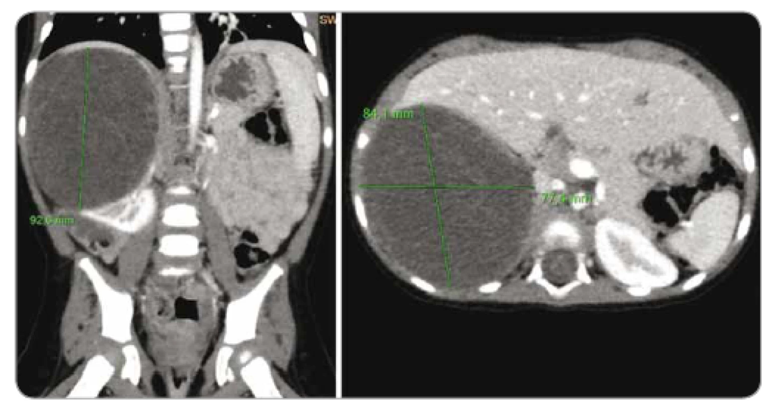 Počítačová tomografie břicha pacientky z kazuistiky 3 – cystický nefrom pravé
ledviny.