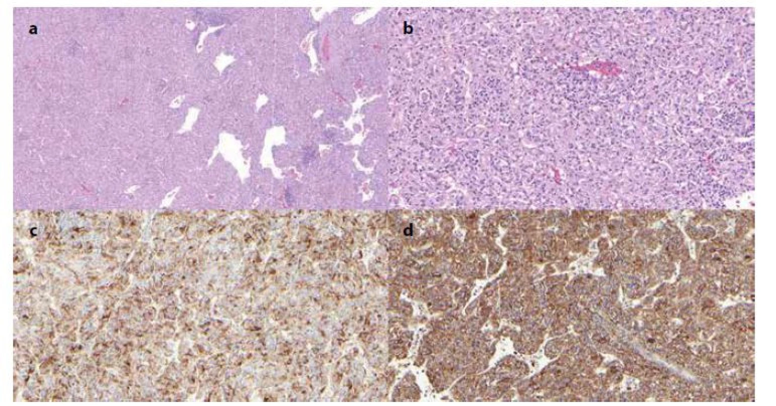 Histologické řezy preparátu angiomyolipomu
2a − Hematoxylin-Eosin barvení, zvětšení 5×; 2b − Hematoxylin-Eosin barvení, zvětšení 200×;
2c − HMB-45 imunohistochemické barvení, zvětšení 200×; 2d − Cathepsin K imunohistochemické barvení, zvětšení 200×.<br>
Fig. 2: Histological samples of the angiomyolipoma specimen
2a − Hematoxylin and eosin staining, magnification 50×; 2b − Hematoxylin and eosin staining, magnification 200×; 2c − HMB-45
immunohistochemical staining, magnification 200×; 2d − Cathepsin K immunohistochemical staining, magnification 200×.