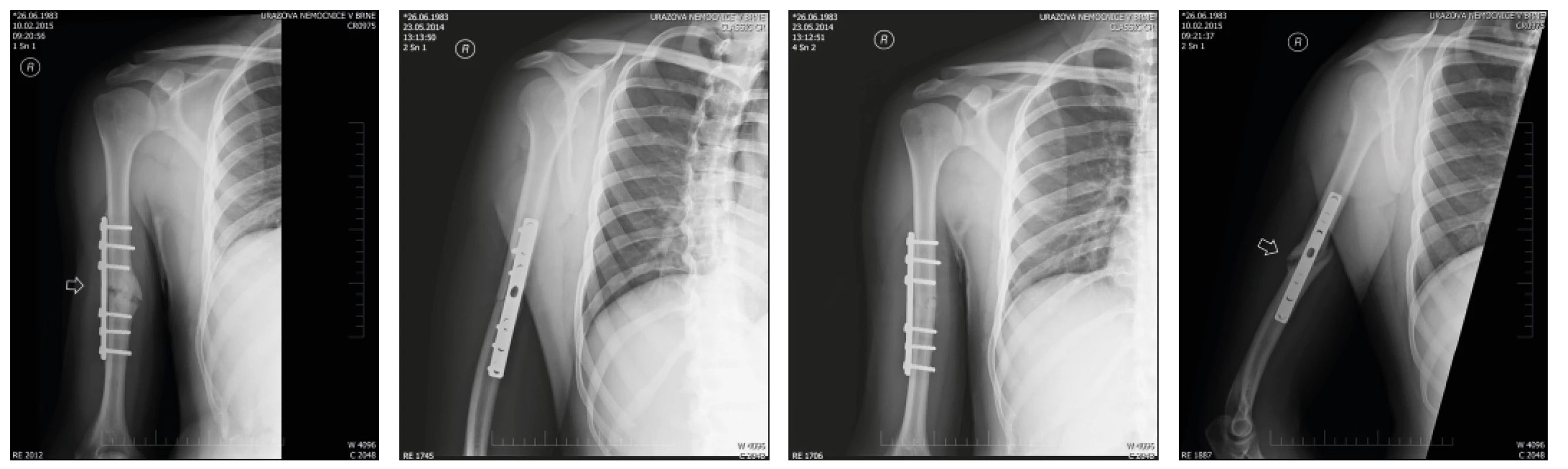 Radiograph of the humerus in anteroposterior and lateral projections. Postoperative radiograph (2a) and radiograph taken 9 months after injury (2b) depict a nail osteosynthesis of diaphyseal humeral fracture type A2. Stabilization  with auto-compression plate with insufficient compression at the fracture line resulted in a gradual progression into the non-union