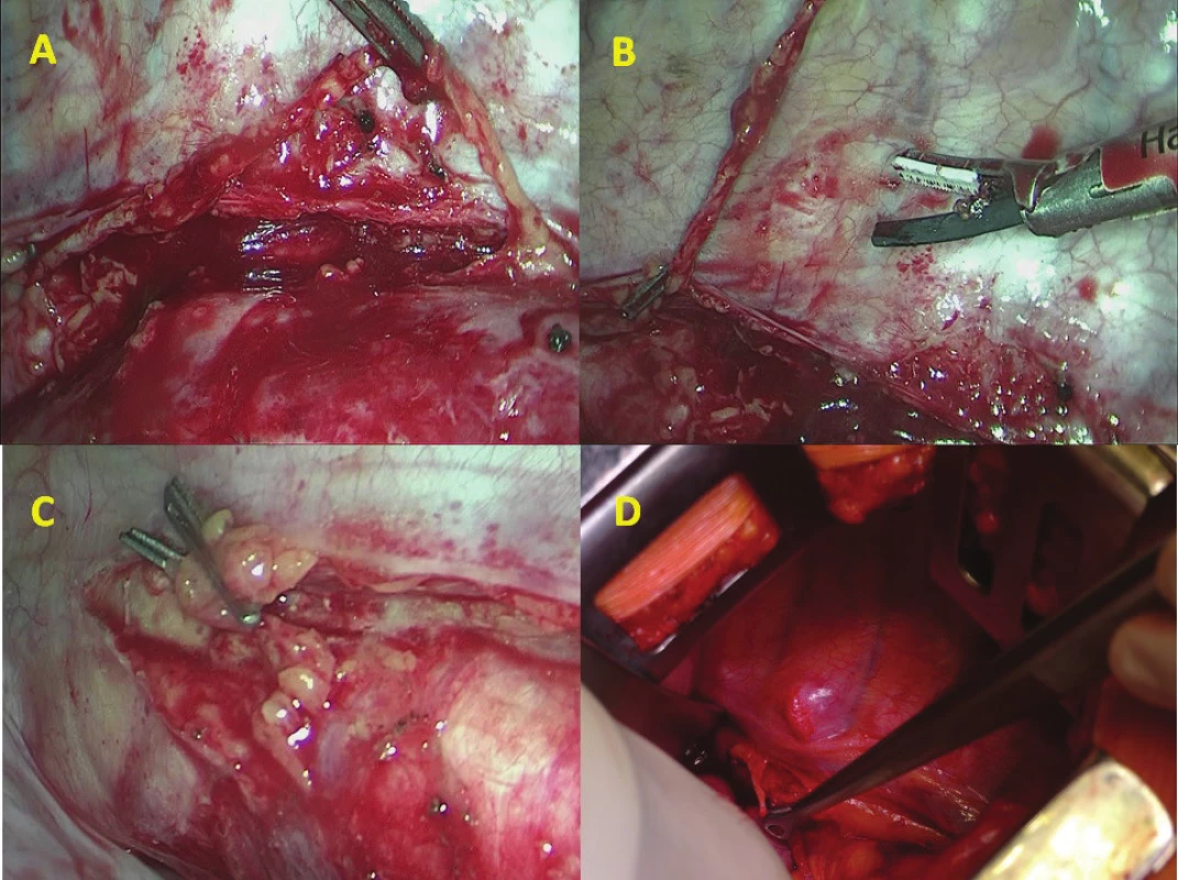 A) torakoskopická preparace DT nad
descendentní aortou (pronační poloha);
B) torakoskopická klipace a přerušení DT;
C) dvojitý klip supradiafragmaticky; D) Ivor-
-Lewisova ezofagektomie a preparace DT
(pohled z ventrální strany v boční poloze
pacienta)<br>
Fig. 1: A) thoracoscopic preparation of DT
above the descending aorta; B) thoracoscopic
clipping and dissection of DT; C) double
clip above the diaphragm; D) Ivor-Lewis
resection and prophylactic ligation of the
thoracic duct (view from the ventral side in
left lateral decubitus position