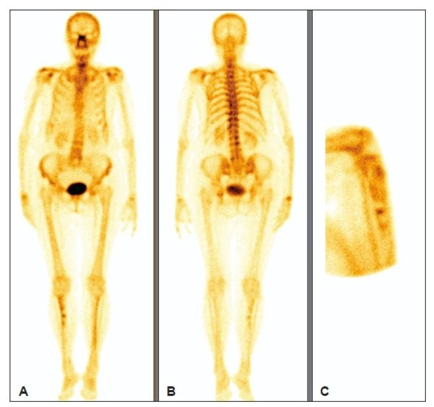 Celotělový kostní obraz (A – pohled přední, B – pohled zadní) a cílený boční obraz pravého kolena (C). Je patrná nepravidelně zvýšená akumulace radiofarmaka v proximální části pravé tibie.