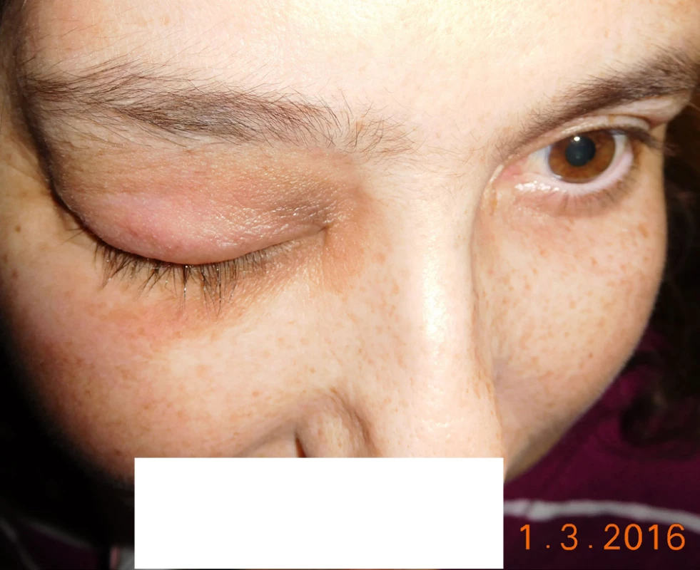Patient in 3/2016, eyelids are without inflammation