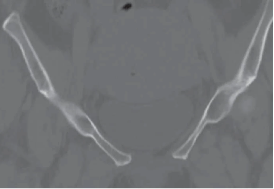 Rozstup symfýzy na koronárnych 2D rekonštrukciach panvy.<br>
Fig. 3. Symphysis separation on CT 2D coronary pelvic scans.