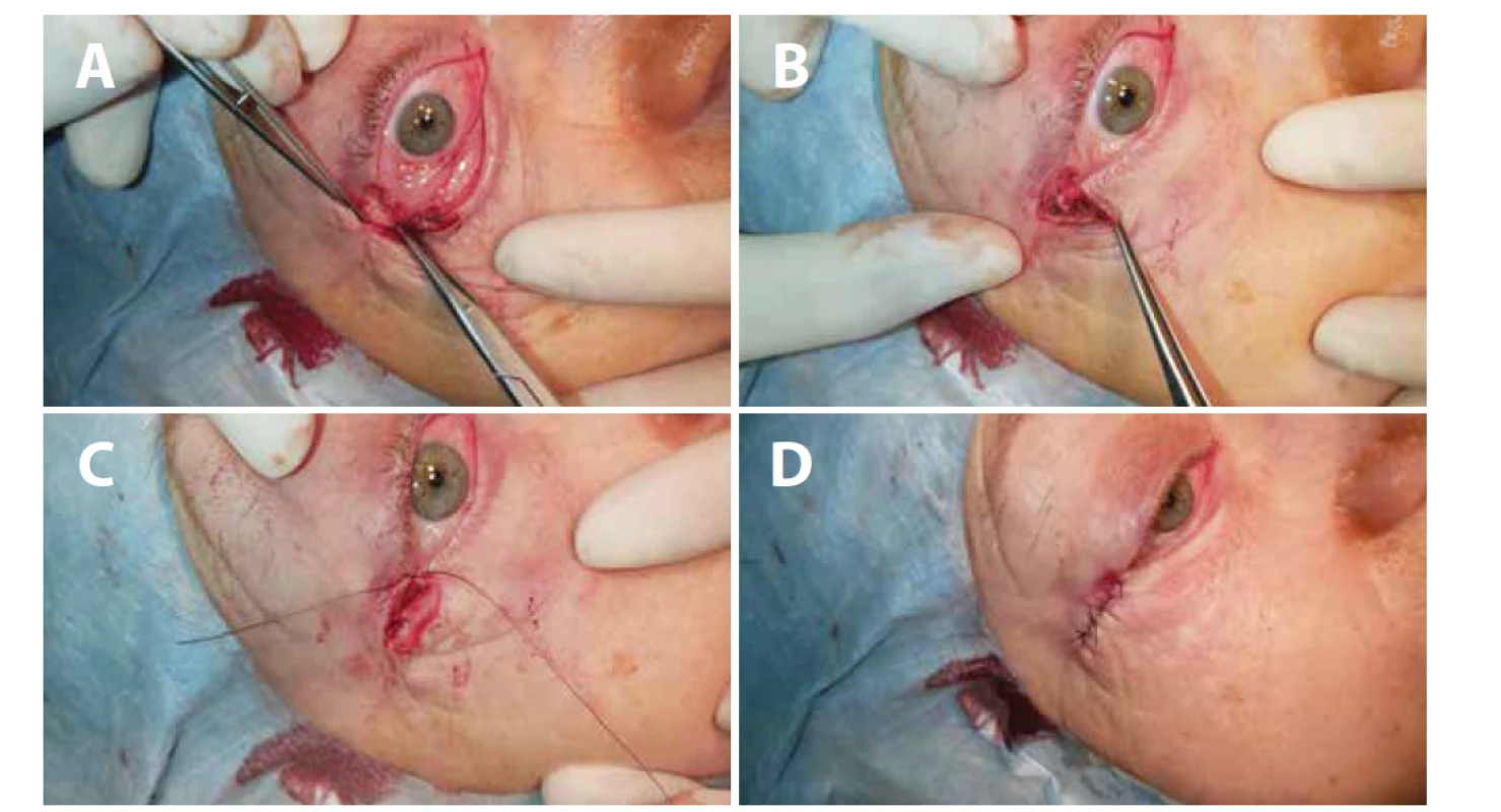 (A) Ektropium pravého oka – vizualizace periostu, (B) fixace proužku tarzu k periostu, (C) první steh zachovávající ostrý
úhel, (D) sutura kůže